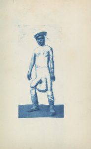 Elephantiasis, c. 1870s