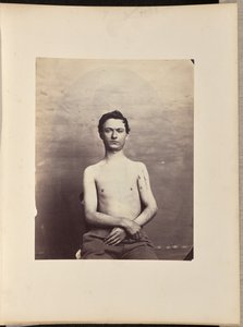 Recovery after Excision of the Head of the Left Humerus for Gunshot Fracture by William H. Bell