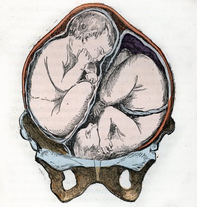 Representation of the good position of two fetuses during a gemellar pregnancy Engraving from 