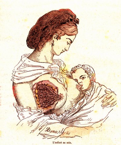 The Child in the Breast (J. Rengade