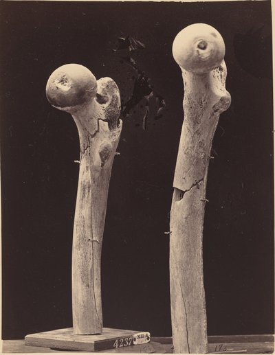 Specimens of Gunshot Fractures of the Femur by American 19th Century