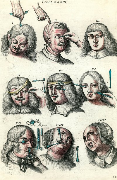 Surgery in the 18th century: Trepanation and operation of the eye and face. Engraving in 