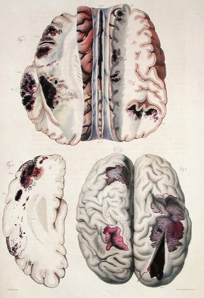 Capillary apoplexy, from 