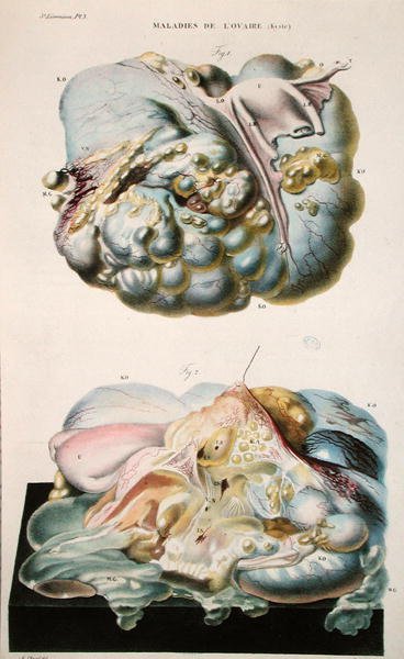 Diseases of the Ovaries, from 