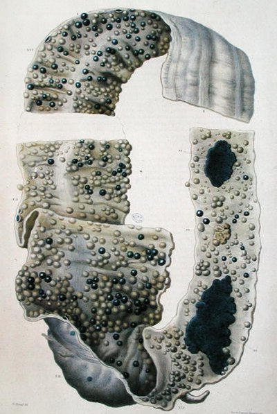 Diseases of the Intestines, from 