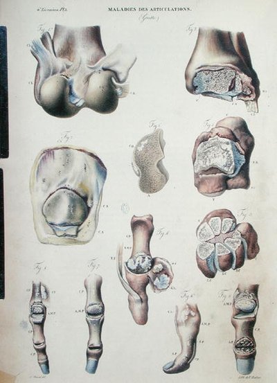 Diseases of the joints, from 