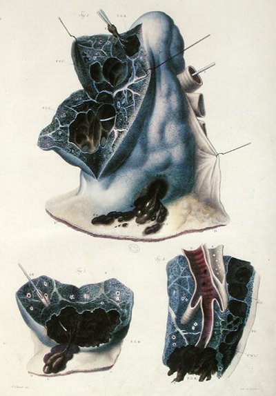 Diseases of the Lungs, from 