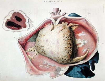 Pericarditis, plate depicting heart diseases from Anatomie pathologique du corps humain by Jean Cruveilhier (1791-1874), published in Paris by Antoine Chazal