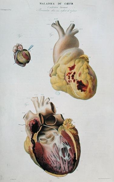Plate depicting heart diseases. Spontaneous rupture of the heart of an 86 year old woman and pericarditis in a six day old baby, from 