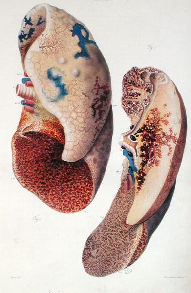 Pneumonia, from 