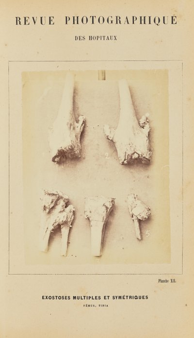 Multiple and Symmetrical Exostoses, Femur, Tibia by Arthur de Montmeja