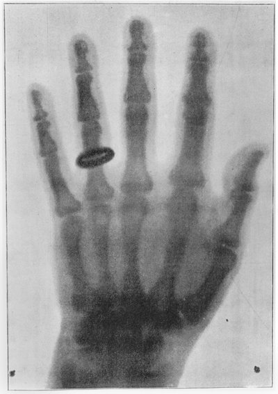 X-ray of the Left Hand of Anna Bertha Ludwig, Röntgen