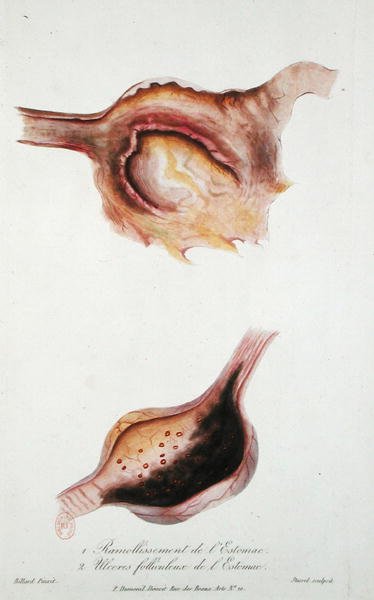 Softening and follicular ulcers of the stomach, from 