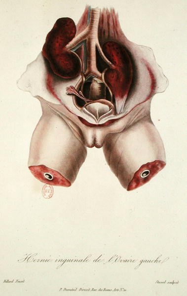 Inguinal hernia of the left ovary, from 
