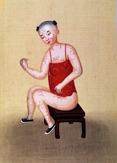 Child with smallpox by Chinese School