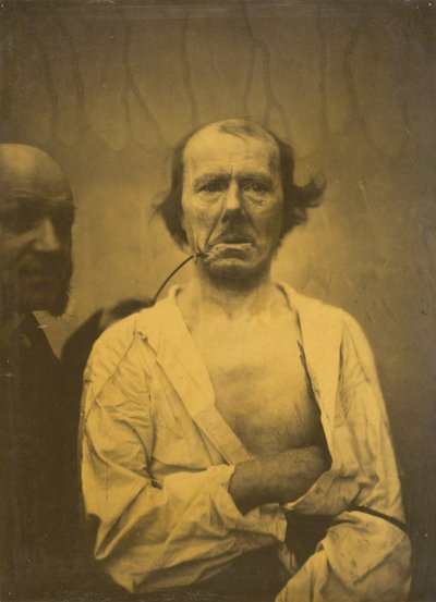 A Relaxed Expression Left, Disgust Right, 1854-1856, printed 1862 by Duchenne de Boulogne