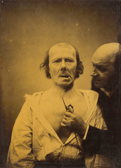 This Contraction of M. Platysma Alone Lacks Expression, 1854-1856, printed 1862 by Duchenne de Boulogne