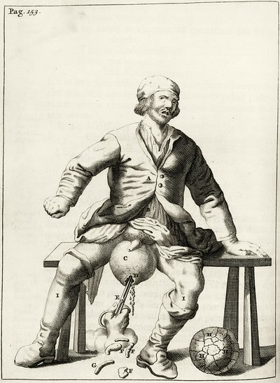 Draining fluid from a Hydrocele of the Scrotum, from Exercitationes Practicae circa Medendi Methodum by Frederik Dekkers, 1694 by Dutch School