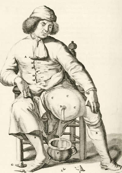 Draining fluid from an abscess, from Exercitationes Practicae circa Medendi Methodum by Frederik Dekkers, 1694 by Dutch School