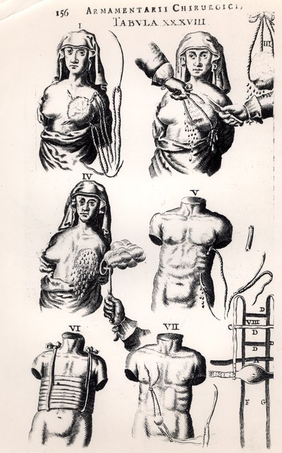 Operating on breast cancer, from Armamentarii Chirurgici by Johannes Schultes published in Amsterdam, 1672 by Dutch School