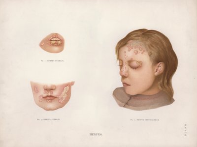 Diseases of the Skin: Herpes by English School