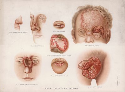 Diseases of the Skin: Rodent Ulcer and Epithelioma by English School