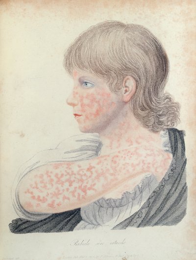 German measles, illustration for a book by Robert Willan, 1808 by English School