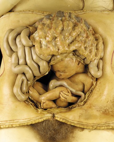 Anatomical Model of an Ovarian Pregnancy (detail) by European School