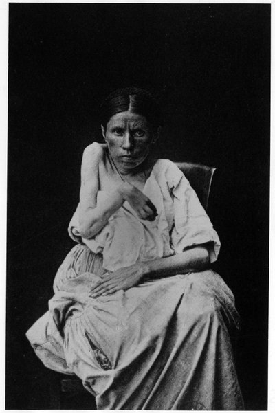 Photograph of a patient suffering from hemiplegic epilepsy, in 