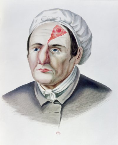 After a Skin Graft Operation, from Selecta Praxis Medico-Chirurgica by Alexander Auvert, Paris, 1856 by French School