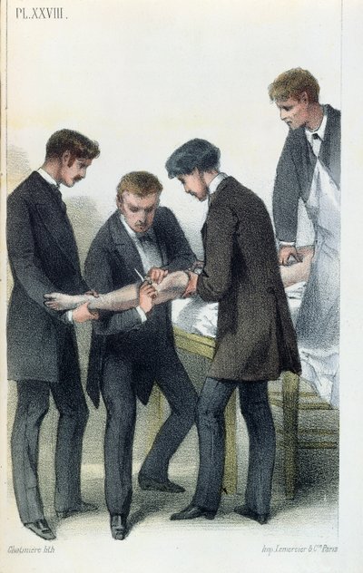 Amputating an arm, from a medical manual by Jean-Baptiste-Leon Dubreuil by French School