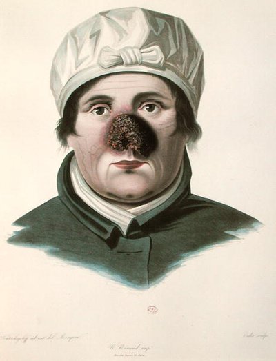 Before a skin graft operation, from 