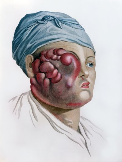 Cancerous scrofula, from Description des Maladies de la Peau by Baron Jean Louis Alibert by French School