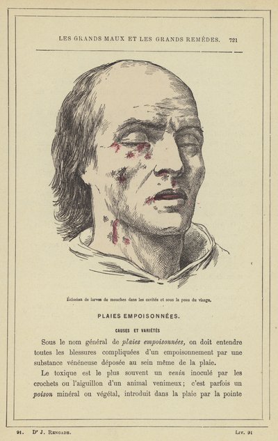 Hatching of Fly Larvae in Cavities and Under the Skin of the Face by French School