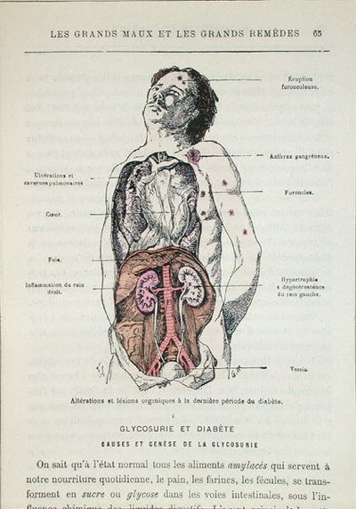 Effects of diabetes, from 