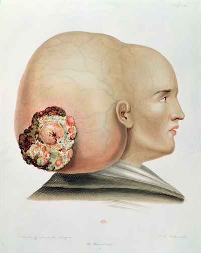 Fungus of the Dura Mater, from Selecta Praxis Medico-Chirurgica by Alexander Auvert by French School