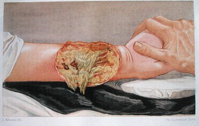 Hospital Gangrene, from 