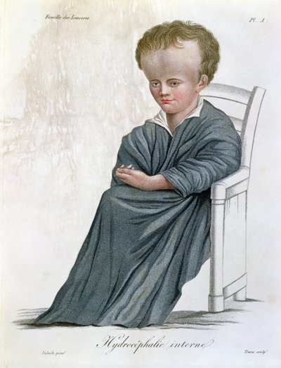 Internal Hydrocephalus, from Nosologie Naturelle by Baron Jean Louis Alibert engraved by Tresca by French School