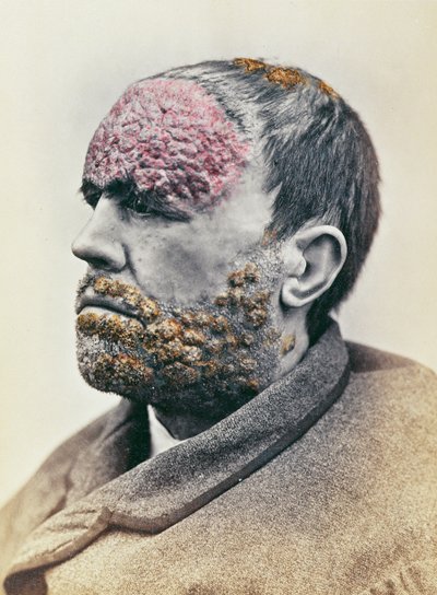 Man suffering from syphilis, from a photograph taken for the Clinique Photographique de l