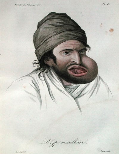 Maxillary polyp, from a book by Baron Jean Louis Alibert by French School