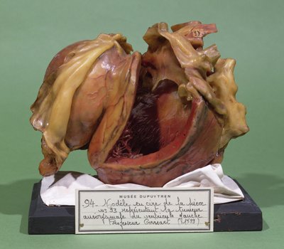 Model of a tumour of the left ventricle, 1799 by French School