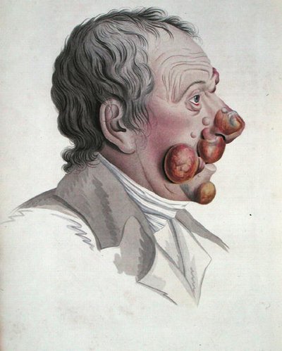 Mycosis Fongoide, from a book by Baron Jean Louis Alibert by French School