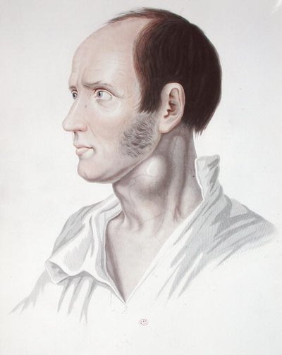 Patient with an Aneurism, from 