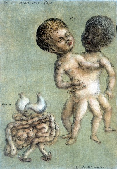 Plate of Medicine Representing Siamese Brothers: a White and a Black. Illustration by Toussaint (1756) in 