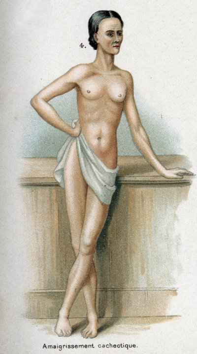 Portrait of a Woman with Cachectic Weight Loss by French School