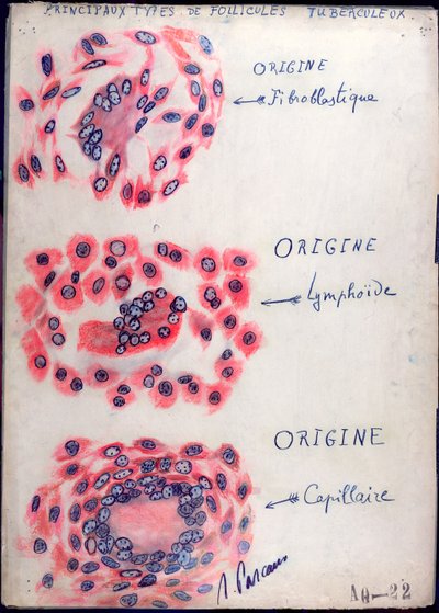 Principle tuberculosis follicles by French School