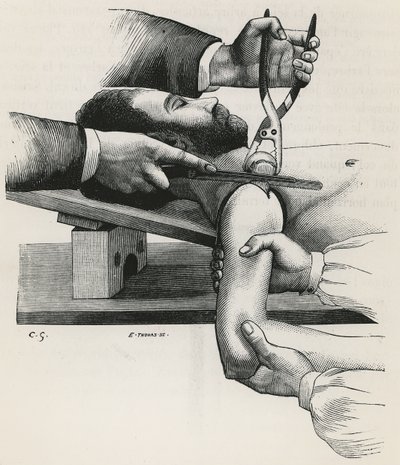 Resection of the Shoulder (from 