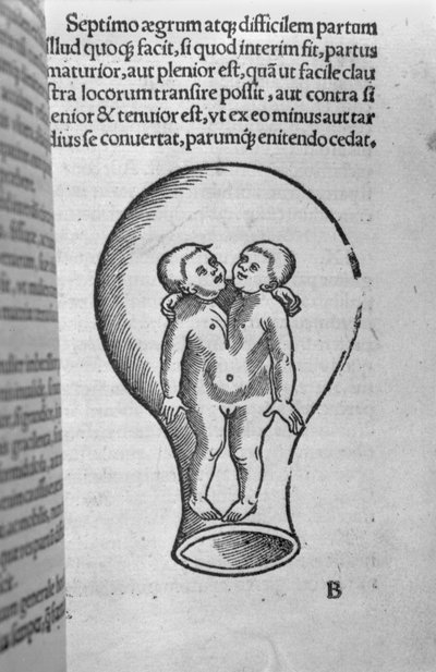 Siamese children, illustration from the so-called Rhodion manuscript by French School