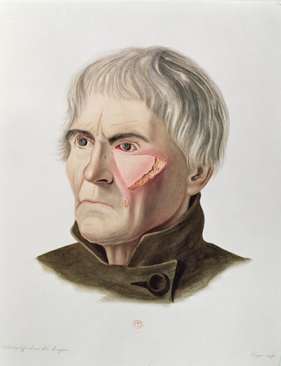 Skin Graft Operation, from Selecta Praxis Medico-Chirurgica by Alexander Auvert by French School