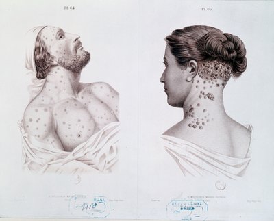 Symptoms of syphilis in men and women, from a medical book by French School